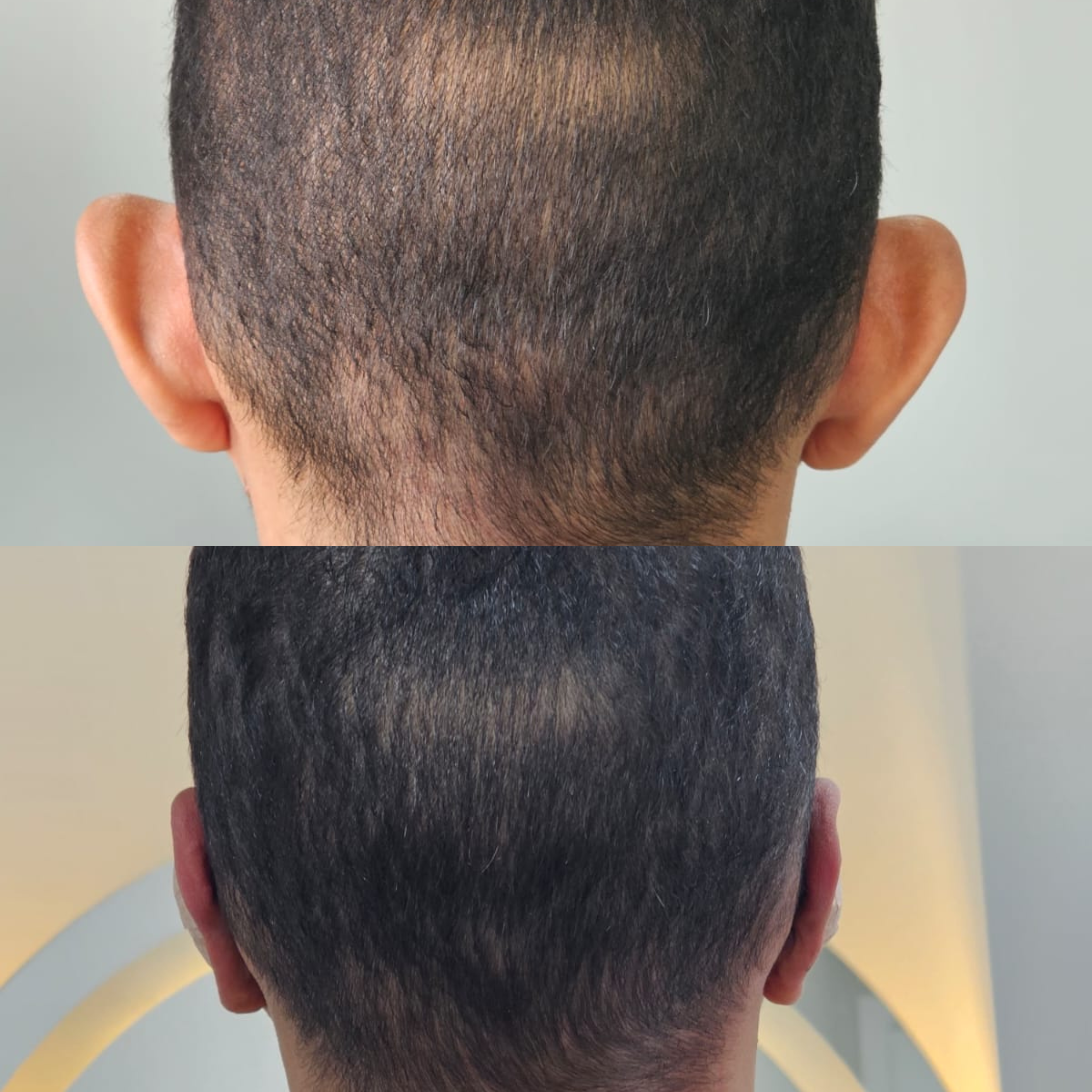 Antes e Depois Otoplastia